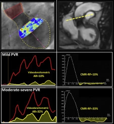 A Novel Angiographic Quantification of Aortic Regurgitation After TAVR Provides an Accurate Estimation of Regurgitation Fraction Derived From Cardiac Magnetic Resonance Imaging