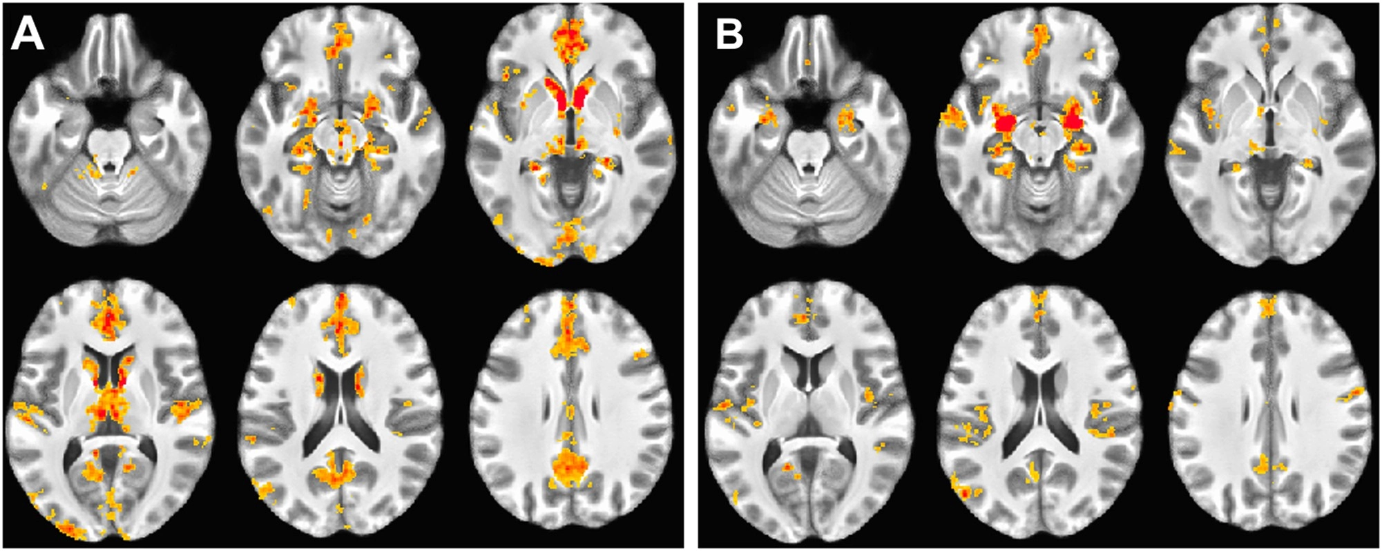 Extended amygdala connectivity changes during sustained shock anticipation