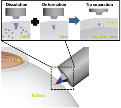 Rapidly Detachable Microneedles Using Porous Water‐Soluble Layer for Ocular Drug Delivery